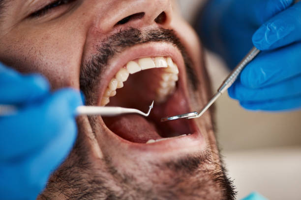 Best Emergency Wisdom Teeth Removal in Wilkes Barre, PA