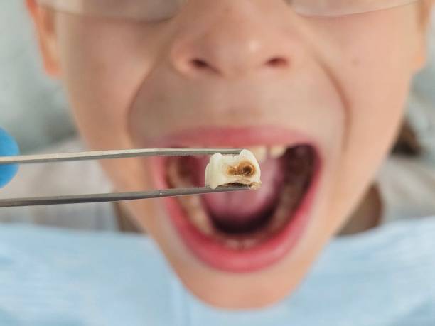 Best Emergency Broken Tooth Repair in Wilkes Barre, PA